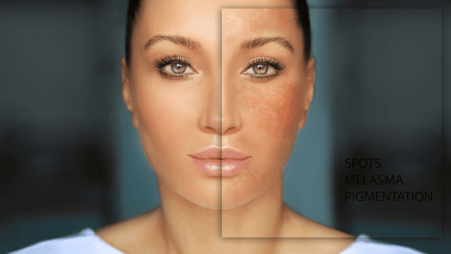 מלמזה בפנים אישה עם מלמזה בפנים